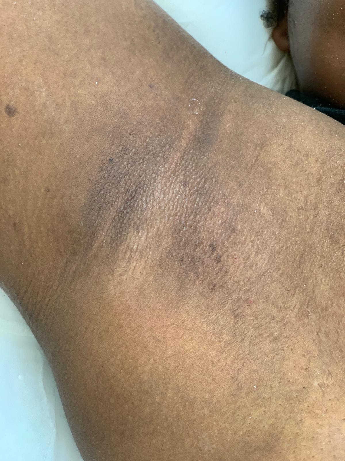 After laser hair removal treatment, example 1