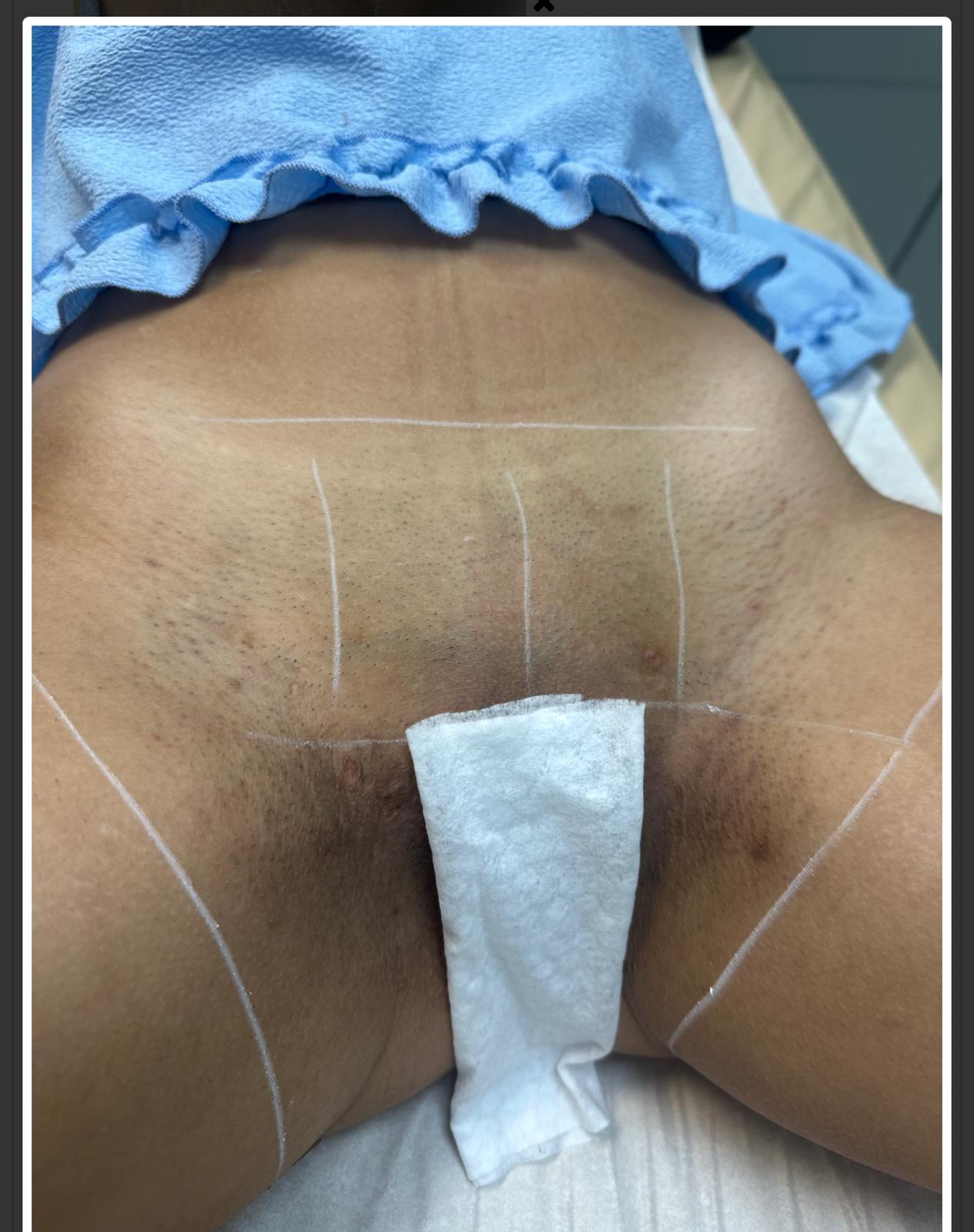 After laser hair removal treatment, example 3