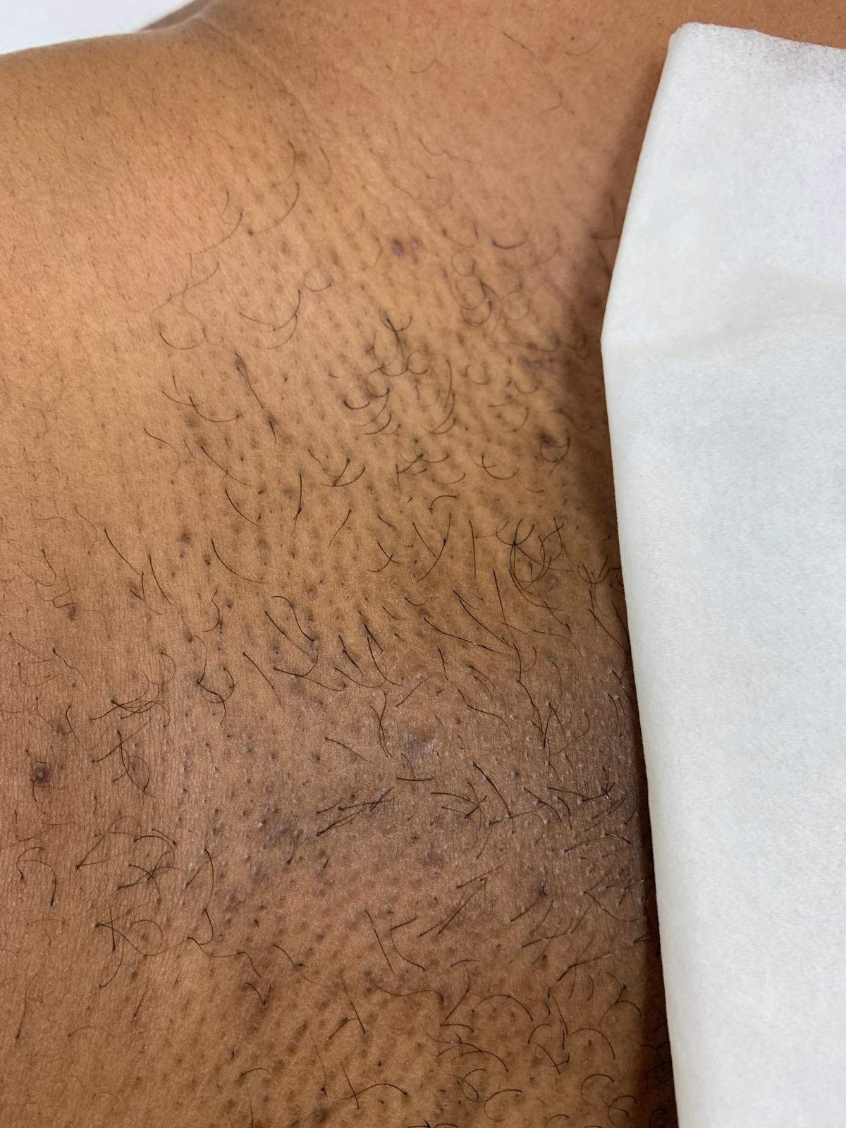 Before laser hair removal treatment, example 2