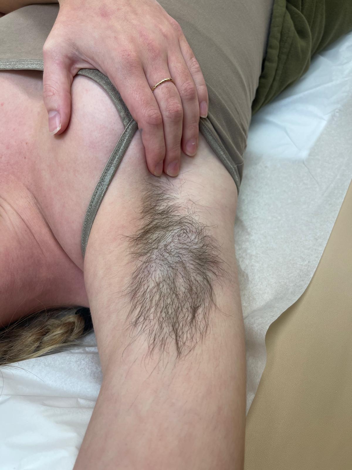 Before underarm laser hair removal result at Natura Spa