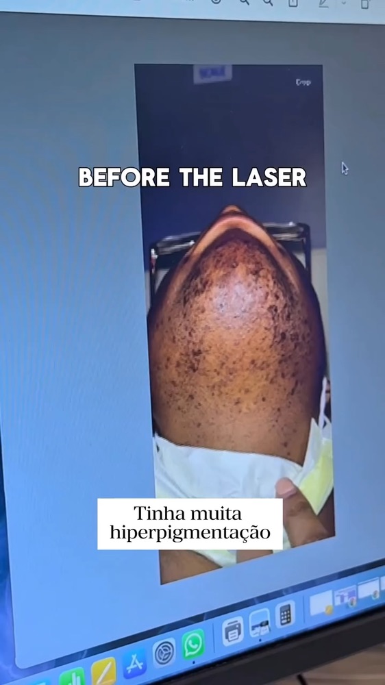 Video showing real laser hair removal before and after results